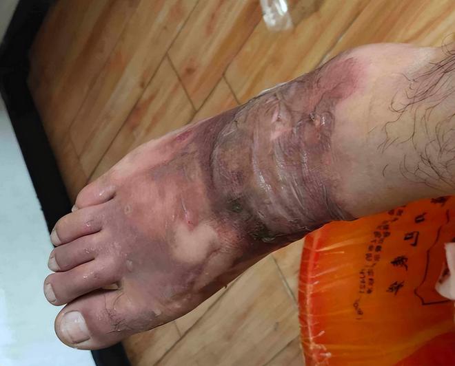 必威冷水壶烫伤老人家属索赔10000元厂家:我让你往里放烫水的(图6) 必威冷水壶烫伤老人家属索赔10000元厂家:我让你往里放烫水的(图6)